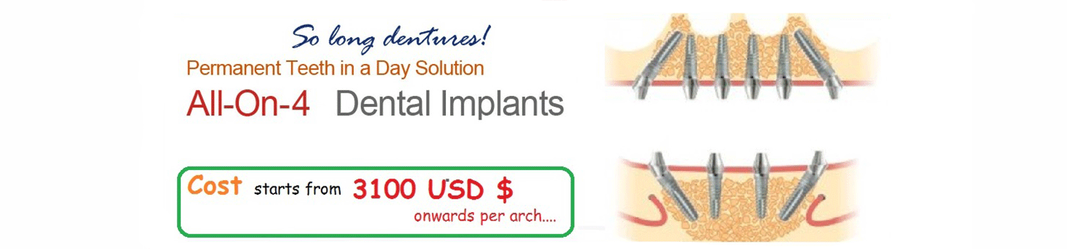 All on 4 Implants India