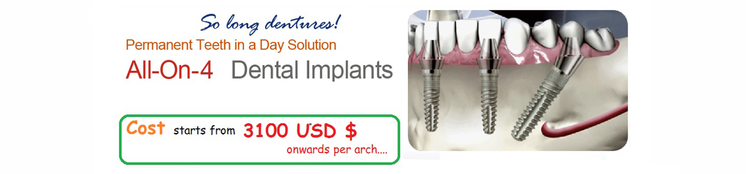 All on 4 Implants India